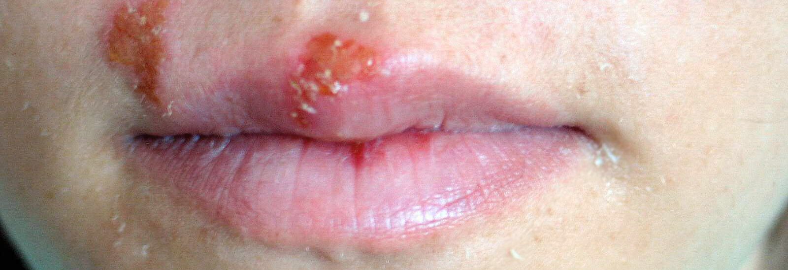 The Causes Of Cold Sores And How To Treat The Symptoms Your Skin
